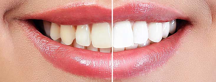 Bleaching Vorher Nachher