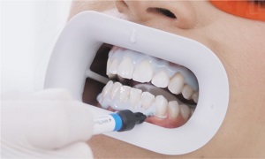Gingiva schützen