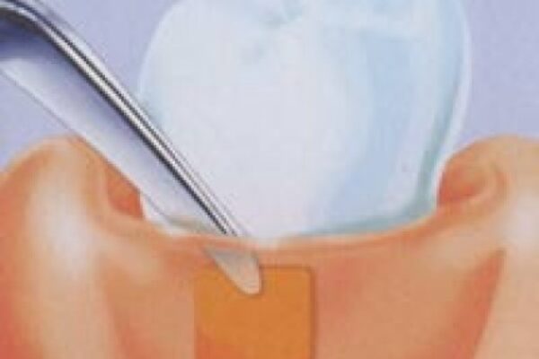 PerioChip – Parodontitisbehandlung ohne Antibiotika