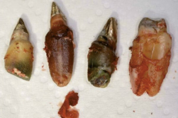 Warum ein toter Zahn mehr als nur ein Zahnproblem ist