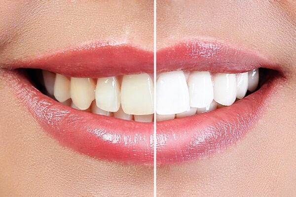 Bleaching – Professionelle Zahnaufhellung